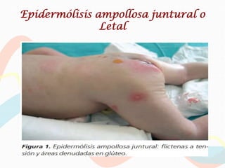 Epidermólisis ampollosa juntural o
               Letal
 