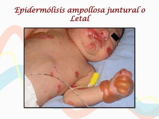 Epidermólisis ampollosa juntural o
               Letal
 