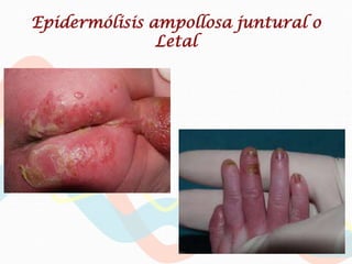 Epidermólisis ampollosa juntural o
               Letal
 