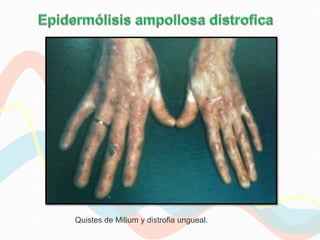 Quistes de Milium y distrofia ungueal.
 