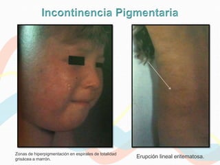 Zonas de hiperpigmentación en espirales de totalidad
grisácea a marrón.
                                                       Erupción lineal eritematosa.
 