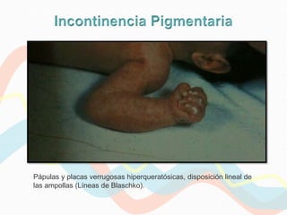 Pápulas y placas verrugosas hiperqueratósicas, disposición lineal de
las ampollas (Líneas de Blaschko).
 