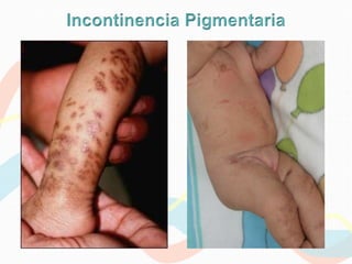 Epidermólisis ampollosa