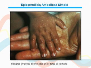 Epidermólisis Ampollosa Simple




Múltiples ampollas diseminadas en el dorso de la mano
 