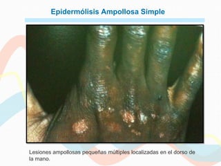 Epidermólisis Ampollosa Simple




Lesiones ampollosas pequeñas múltiples localizadas en el dorso de
la mano.
 