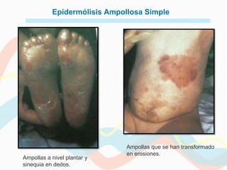 Epidermólisis Ampollosa Simple




                              Ampollas que se han transformado
                              en erosiones.
Ampollas a nivel plantar y
sinequia en dedos.
 