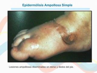 Epidermólisis Ampollosa Simple




Lesiones ampollosas diseminadas en dorso y dedos del pie.
 