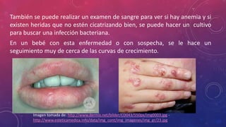 También se puede realizar un examen de sangre para ver si hay anemia y si
existen heridas que no estén cicatrizando bien, se puede hacer un cultivo
para buscar una infección bacteriana.
En un bebé con esta enfermedad o con sospecha, se le hace un
seguimiento muy de cerca de las curvas de crecimiento.
Imagen tomada de: http://www.dermis.net/bilder/CD043/550px/img0003.jpg -
http://www.esteticamedica.info/data/img_cont/img_imagenes/img_gr/23.jpg
 