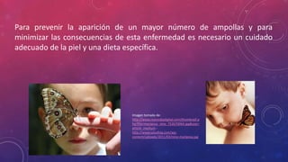 Para prevenir la aparición de un mayor número de ampollas y para
minimizar las consecuencias de esta enfermedad es necesario un cuidado
adecuado de la piel y una dieta específica.
Imagen tomada de:
http://www.nuevodiadigital.com/thumbnail.p
hp?file=mariposa_nino_752670064.jpg&size=
article_medium -
http://www.saluding.com/wp-
content/uploads/2011/03/nino-mariposa.jpg
 