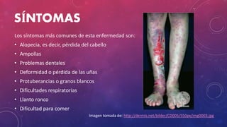SÍNTOMAS
Los síntomas más comunes de esta enfermedad son:
• Alopecia, es decir, pérdida del cabello
• Ampollas
• Problemas dentales
• Deformidad o pérdida de las uñas
• Protuberancias o granos blancos
• Dificultades respiratorias
• Llanto ronco
• Dificultad para comer
Imagen tomada de: http://dermis.net/bilder/CD005/550px/img0003.jpg
 
