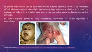 Se puede prescribir el uso de esteroides orales durante periodos cortos, si se presentan
dificultades para deglutir, si en algún momento se llega a presentar cándida en la boca o el
esófago, se deberá ir al médico para que le sea prescrito algún medicamento para la
infección.
La buena higiene dental es muy importante, incluyendo las visitas regulares al
odontólogo.
Imagen tomada de: http://www.actasdermo.org/imatges/103/103v100n10/grande/103v100n10-13145682fig6.jpg
 