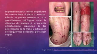 Se pueden necesitar injertos de piel para
las áreas cutáneas ulceradas o desnudas.
Además se pueden recomendar otros
procedimientos quirúrgicos, como la
dilatación del esófago si se presenta
estrechamiento, reparación de las
deformidades de la mano y extirpación
de cualquier tipo de lesiones por cáncer
de piel.
Imagen tomada de: http://www.nature.com/labinvest/journal/v84/n10/images/3700164f1.jpg
 