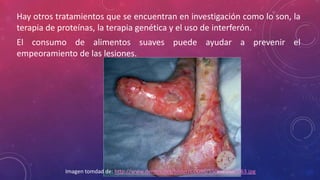 Hay otros tratamientos que se encuentran en investigación como lo son, la
terapia de proteínas, la terapia genética y el uso de interferón.
El consumo de alimentos suaves puede ayudar a prevenir el
empeoramiento de las lesiones.
Imagen tomdad de: http://www.dermis.net/bilder/CD056/550px/img0063.jpg
 