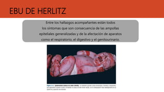 EBU DE HERLITZ
Entre los hallazgos acompañantes están todos
los síntomas que son consecuencia de las ampollas
epiteliales generalizadas y de la afectación de aparatos
como el respiratorio, el digestivo y el genitourinario.
 