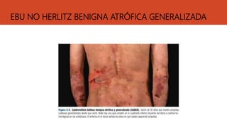 EBU NO HERLITZ BENIGNA ATRÓFICA GENERALIZADA
 