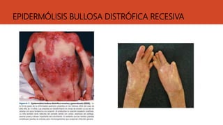 EPIDERMÓLISIS BULLOSA DISTRÓFICA RECESIVA
 