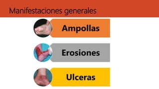 Manifestaciones generales
Ampollas
Erosiones
Ulceras
 