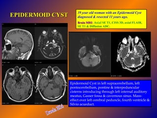 EPIDERMOID CYST

39 year old woman with an Epidermoid Cyst
diagnosed & resected 11 years ago.
Brain MRI: Axial SE T1, CISS 3D, axial FLAIR,
MRI
SE T1 & Diffusion ADC.

Epidermoid Cyst in left supracerebellum, left
pontocerebellum, pontine & interpeduncular
cisterns introducing through left internal auditory
meatus, Gasser fossa & cavernous sinus. Masseffect over left cerebral peduncle, fourth ventricle &
Silvio acueduct.

 