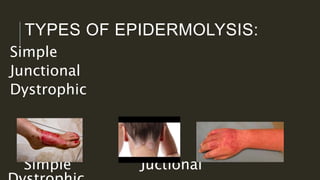 TYPES OF EPIDERMOLYSIS:
Simple
Junctional
Dystrophic
Simple Juctional
 