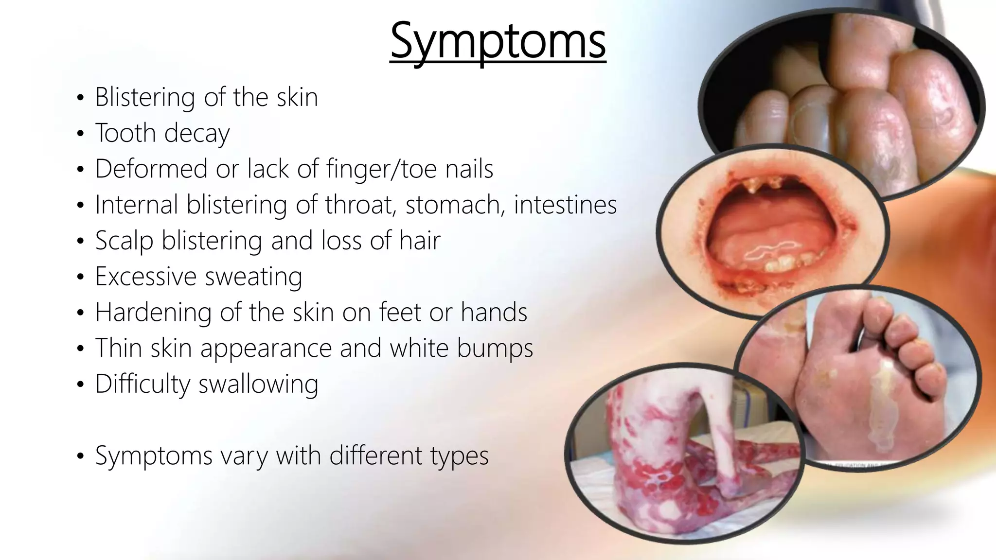 Epidermolysis bullosa | PPTX