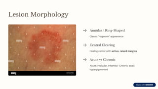 Epidermophyton MBBS 2ND YEAR MICROBIOLOGY | PDF