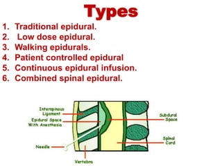Types
1. Traditional epidural.
2. Low dose epidural.
3. Walking epidurals.
4. Patient controlled epidural
5. Continuous ep...