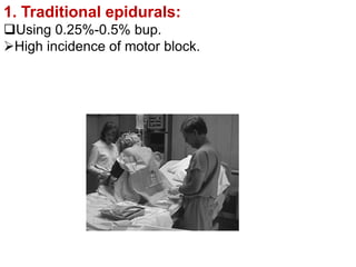 1. Traditional epidurals:
Using 0.25%-0.5% bup.
High incidence of motor block.
 