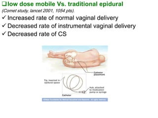 low dose mobile Vs. traditional epidural
(Comet study, lancet 2001, 1054 pts).
 Increased rate of normal vaginal deliver...