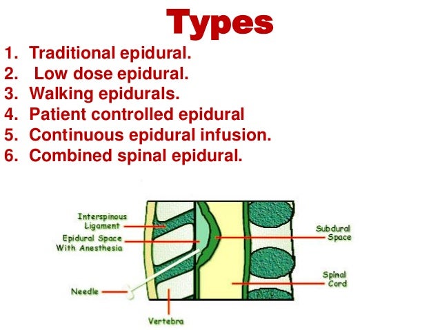 Epidural