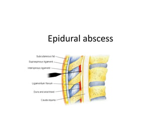 Spinal Epidural Abscess Causes