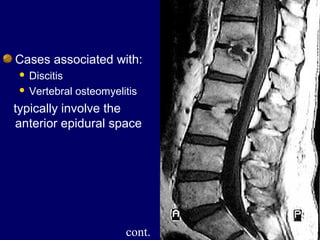 Cases associated with:
 Discitis
 Vertebral osteomyelitis
typically involve the
anterior epidural space
cont.
 