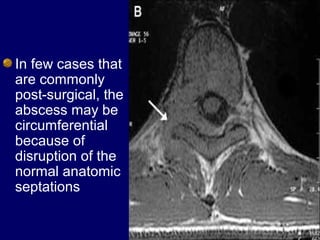 In few cases that
are commonly
post-surgical, the
abscess may be
circumferential
because of
disruption of the
normal anatomic
septations
 
