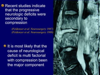 Recent studies indicate
that the progressive
neurologic deficits were
secondary to
compression
(Feldenzer et al. Neurosurgery 1987)
(Feldenzer et al. Neurosurgery 1988)
It is most likely that the
cause of neurological
deficit is multi factorial
with compression been
the major component
 