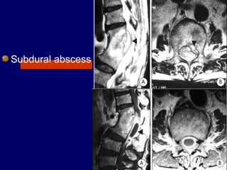 Subdural abscess
 