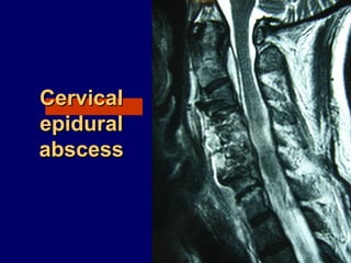 CervicalCervical
epiduralepidural
abscessabscess
 