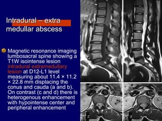 Intradural – extraIntradural – extra
medullar abscessmedullar abscess
Magnetic resonance imaging
lumbosacral spine showing a
T1W isointense lesion
intradural extramedullary
lesion at D12-L1 level
measuring about 11.4 × 11.2
× 22.8 mm displacing the
conus and cauda (a and b).
On contrast (c and d) there is
heterogenous enhancement
with hypointense center and
peripheral enhancement
 
