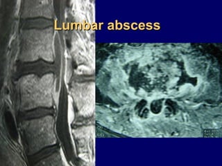 Lumbar abscessLumbar abscess
 