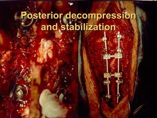 Posterior decompressionPosterior decompression
and stabilizationand stabilization
 
