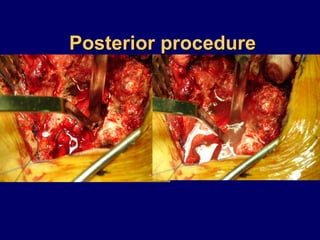 Posterior procedurePosterior procedure
 