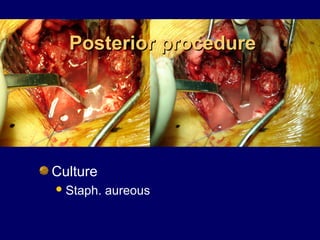 Posterior procedurePosterior procedure
Culture
Staph. aureous
 