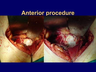 Anterior procedureAnterior procedure
 
