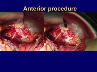 Anterior procedureAnterior procedure
 