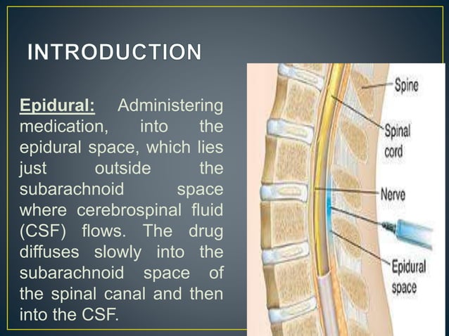 Epidural Administration Guidelines – AUXR