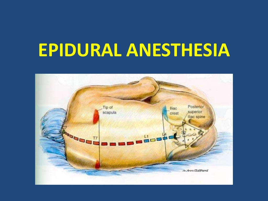 Epidural anesthesia