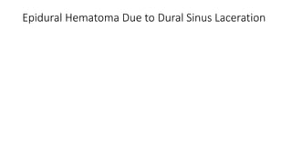 Epidural Hematoma Due to Dural Sinus Laceration
 