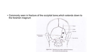 • Commonly seen in fracture of the occipital bone,which extends down to
the foramen magnum
 