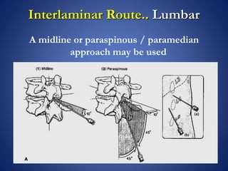 Paraspinous Injection Epidural injections | PPTX