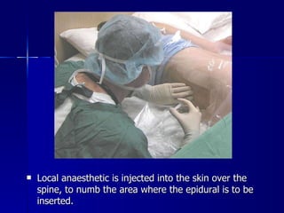 Local anaesthetic is injected into the skin over the spine, to numb the area where the epidural is to be inserted. 