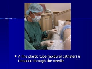 A fine plastic tube (epidural catheter) is threaded through the needle. 