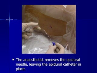 The anaesthetist removes the epidural needle, leaving the epidural catheter in place. 